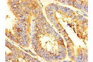 Immunohistochemistry of paraffin-embedded human endometrial cancer using ABIN7154164 at dilution of 1:100 (GPD2 抗体  (AA 43-727))