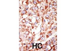 Formalin-fixed and paraffin-embedded human hepatocellular carcinoma tissue reacted with the ACSL3 polyclonal antibody  , which was peroxidase-conjugated to the secondary antibody, followed by DAB staining. (Acsl3 抗体  (N-Term))