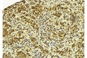 ABIN6272950 at 1/100 staining Human breast cancer tissue by IHC-P.