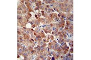 Immunohistochemistry analysis in human hepatocarcinoma using CHRDL1 / NRLN1  Antibody  (N-term), followed by peroxidase conjugation of the secondary antibody and DAB staining. (CHRDL1 抗体  (N-Term))