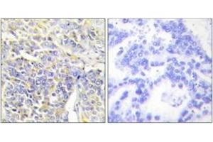 Immunohistochemistry analysis of paraffin-embedded human lung carcinoma tissue, using KAD1 Antibody . (Adenylate Kinase 1 抗体  (AA 101-150))