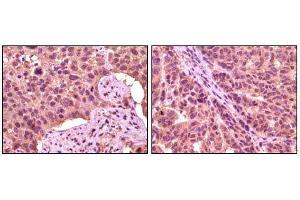 Immunohistochemical analysis of paraffin-embedded human lung carcinoma (left) and skin carcinoma (right), showing cytoplasmic localization using GSK3 aphpa mouse mAb with DAB staining. (GSK3 alpha 抗体)