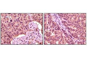 Immunohistochemical analysis of paraffin-embedded human lung carcinoma (left) and skin carcinoma (right), showing cytoplasmic localization using GSK3 aphpa mouse mAb with DAB staining.