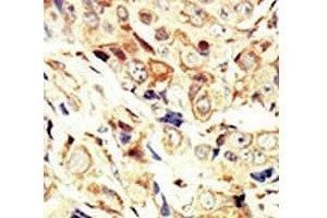 IHC analysis of FFPE human breast carcinoma tissue stained with the IGF1R antibody (IGF1R 抗体  (AA 19-51))