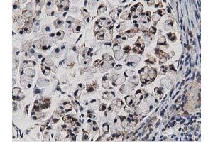 Immunohistochemical staining of paraffin-embedded Adenocarcinoma of Human colon tissue using anti-TACC3 mouse monoclonal antibody. (TACC3 抗体)