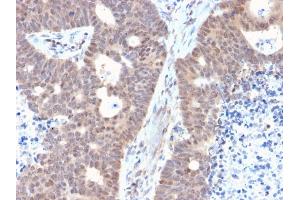 Formalin-fixed, paraffin-embedded human Colon Carcinoma stained with FAF1 Mouse Monoclonal Antibody (CPTC-FAF1-2).