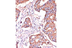 Immunohistochemistry of paraffin-embedded Human colon carcinoma using [KO Validated] IFITM3 Rabbit pAb (ABIN6130482, ABIN6142186, ABIN6142187 and ABIN7101416) at dilution of 1:100 (40x lens). (IFITM3 抗体  (AA 1-133))