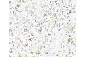 Immunohistochemistry of paraffin-embedded Human gastric cancer using EIF3J Polyclonal Antibody at dilution of 1:100 (40x lens).
