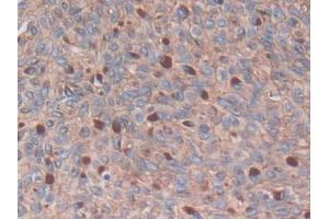 DAB staining on IHC-P; Samples: Human Skin cancer Tissue (S100A14 抗体  (AA 1-91))
