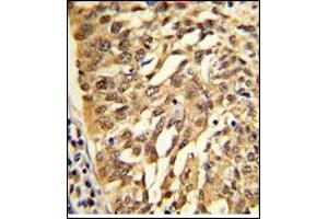 AP17730PU-N SAR1A Antibody (Center) staining of Formalin-Fixed, Paraffin-Embedded Human lung carcinoma.