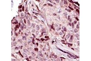 IHC analysis of FFPE human breast carcinoma tissue stained with the IRAK4 antibody (IRAK4 抗体  (AA 5-36))