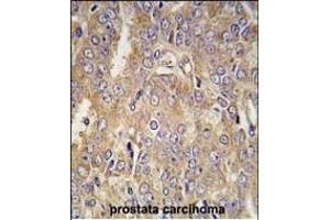 Formalin-fixed and paraffin-embedded human prostata carcinoma tissue reacted with LTBP1 antibody (C-term) (ABIN392207 and ABIN2841907) , which was peroxidase-conjugated to the secondary antibody, followed by DAB staining. (LTBP1 抗体  (C-Term))