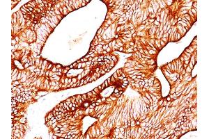 Formalin-fixed, paraffin-embedded human Colon Carcinoma stained with Cytokeratin 8/18 Monoclonal Antibody (KRT8/803 + KRT18/835). (KRT8, KRT18 抗体)