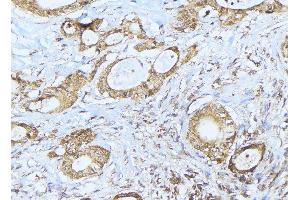 ABIN6275239 at 1/100 staining Human lung cancer tissue by IHC-P.