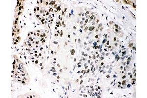 IHC-P staining of human oesophagus squama cancer tissue (p300 抗体  (AA 2065-2414))