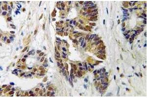 Immunohistochemistry (IHC) analyzes of GRK 2 antibody in paraffin-embedded human colon carcinoma tissue. (GRK2 抗体)