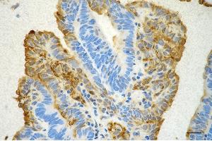Immunohistochemistry was performed on paraffin-embedded human endometrial carcinoma using annexin A1 antibody (ABIN7797614), 1:200). (Recombinant Annexin a1 抗体)
