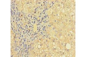 Immunohistochemistry of paraffin-embedded human liver cancer using ABIN7164277 at dilution of 1:100 (PRICKLE4 抗体  (AA 1-240))