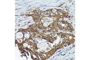 Immunohistochemistry of paraffin-embedded human colon carcinoma using FERMT2 Rabbit pAb (ABIN6131926, ABIN6140582, ABIN6140583 and ABIN6224757) at dilution of 1:300 (40x lens). (FERMT2 抗体  (AA 380-550))