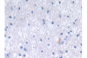 Detection of DEFa3 in Human Glioma Tissue using Polyclonal Antibody to Defensin Alpha 3, Neutrophil Specific (DEFa3) (DEFa3 抗体  (AA 21-94))