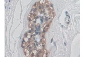 Detection of CD300c in Human Breast cancer Tissue using Polyclonal Antibody to CD300 Antigen Like Family Member C (CD300c) (CD300c 抗体  (AA 21-183))
