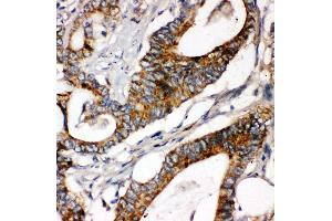 Anti-Laminin gamma 1 antibody, IHC(P) IHC(P): Human Intestinal Cancer Tissue (Laminin gamma 1 抗体  (C-Term))