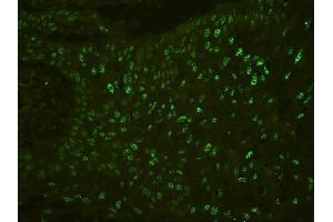 IF analysis of PHF21A using anti-PHF21A antibody (ABIN6719353) PHF21A was detected in paraffin-embedded section of human oesophagus squama cancer tissues. (PHF21A 抗体  (AA 1-97))