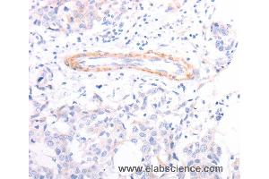 Immunohistochemistry of Human breast cancer using TPM1 Polyclonal Antibody at dilution of 1:40 (Tropomyosin 抗体)