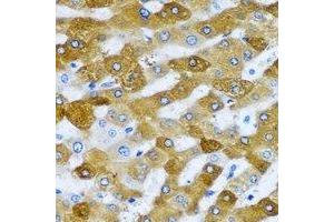 Immunohistochemical analysis of RPL9 staining in human liver cancer formalin fixed paraffin embedded tissue section. (RPL9 抗体)
