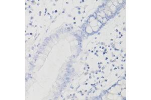 Immunohistochemistry of paraffin-embedded Human intestinal adenocarcinoma (negative control samples) using PD-L1/CD274/CD274 Rabbit mAb (ABIN7266181) at dilution of 1:200 (40x lens). (PD-L1 抗体  (Extracellular Domain))