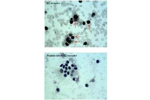 ADORA3 antibody staining of Oral Cell Carcinoma at a dilution of 5 ug/ml (Adenosine A3 Receptor 抗体  (C-Term))