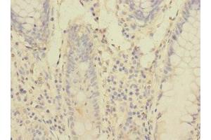 Immunohistochemistry of paraffin-embedded human colon cancer using ABIN7166553 at dilution of 1:100 (Protocadherin 1 抗体  (AA 60-220))