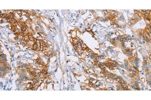 Immunohistochemistry of paraffin-embedded Human colon cancer tissue using CA9 Polyclonal Antibody at dilution 1:50 (CA9 抗体)