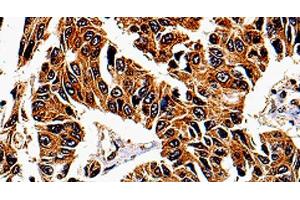 Immunohistochemistry of paraffin-embedded Human lung cancer tissue using IL13RA1 Polyclonal Antibody at dilution 1:50 (IL13 Receptor alpha 1 抗体)