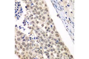 Immunohistochemistry of paraffin-embedded human lung cancer using HDAC2 antibody. (HDAC2 抗体  (C-Term))