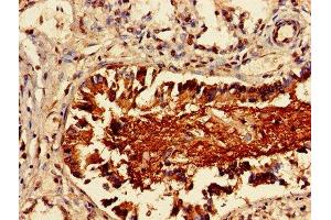Immunohistochemistry of paraffin-embedded human lung cancer using ABIN7158291 at dilution of 1:100 (LAIR1 抗体  (AA 22-165))