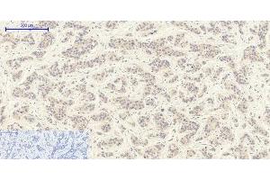 Immunohistochemistry of paraffin-embedded Human liver cancer tissue using TGFB1 Polyclonal Antibody at dilution of 1:200. (TGFB1 抗体)