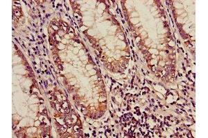 Immunohistochemistry of paraffin-embedded human colon cancer using ABIN7159169 at dilution of 1:100 (Medium-Chain Specific Acyl-CoA Dehydrogenase, Mitochondrial (AA 26-421) 抗体)