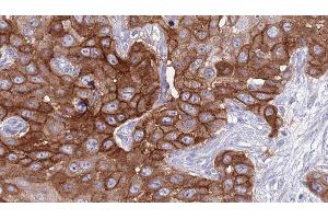ABIN6277036 at 1/100 staining Human Head and neck cancer tissue by IHC-P. (CD94 抗体  (C-Term))