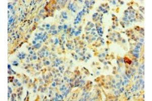 Immunohistochemistry of paraffin-embedded human lung cancer using ABIN7142344 at dilution of 1:100 (MRPL1 抗体  (AA 51-324))