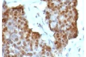 IHC testing of gastric carcinoma stained with Estrogen Receptor beta antibody (ESR2 抗体  (C-Term))