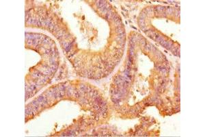 Immunohistochemistry of paraffin-embedded human endometrial cancer using ABIN7166456 at dilution of 1:100 (TPST2 抗体  (AA 26-377))