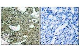 Immunohistochemical analysis of paraffin-embedded human breast carcinoma tissue using MEK1 (phospho- Ser221) antibody (E011161). (MEK1 抗体  (pSer221))