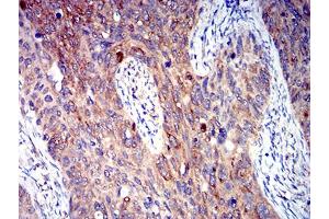 Immunohistochemical analysis of paraffin-embedded cervical cancer tissues using P2RY4 mouse mAb with DAB staining.