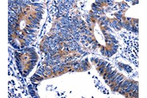 The image on the left is immunohistochemistry of paraffin-embedded Human colon cancer tissue using ABIN7129604(GIP Antibody) at dilution 1/13, on the right is treated with fusion protein. (GIP 抗体)