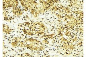 ABIN6269095 at 1/100 staining Human breast cancer tissue by IHC-P.