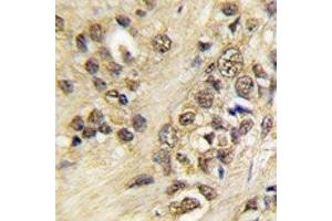 IHC analysis of FFPE human prostate carcinoma tissue stained with Myc antibody