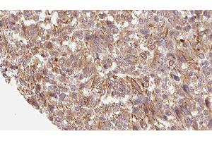 ABIN6279229 at 1/100 staining Human Melanoma tissue by IHC-P. (CALML3 抗体  (Internal Region))