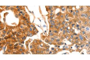 Immunohistochemistry of paraffin-embedded Human lung cancer using MVP Polyclonal Antibody at dilution of 1:30 (MVP 抗体)