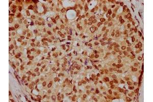 IHC image of ABIN7164247 diluted at 1:200 and staining in paraffin-embedded human breast cancer performed on a Leica BondTM system. (Lamin A/C 抗体  (AA 385-572))